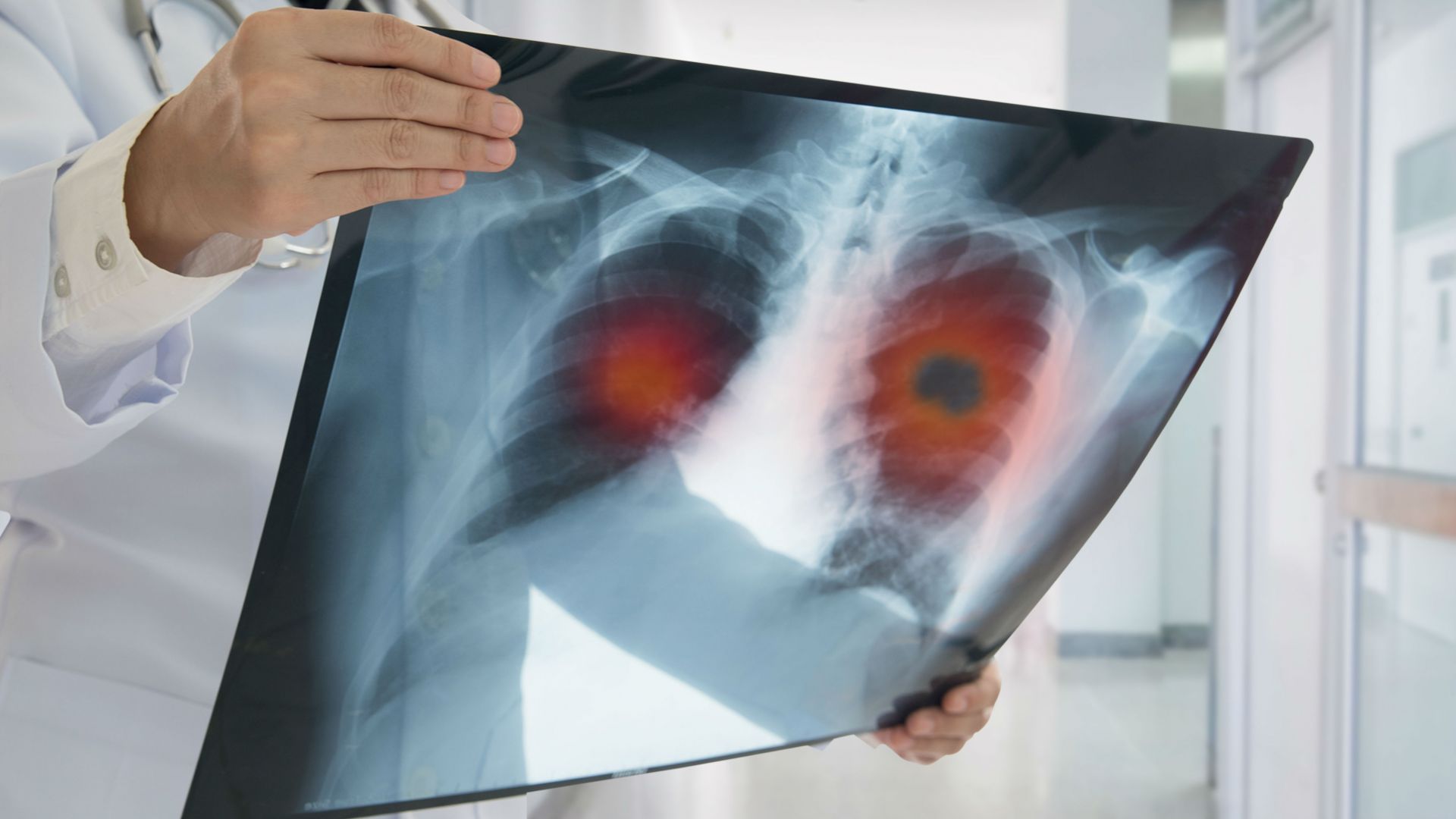 Rak płuc – skąd się bierze i jak mu przeciwdziałać?