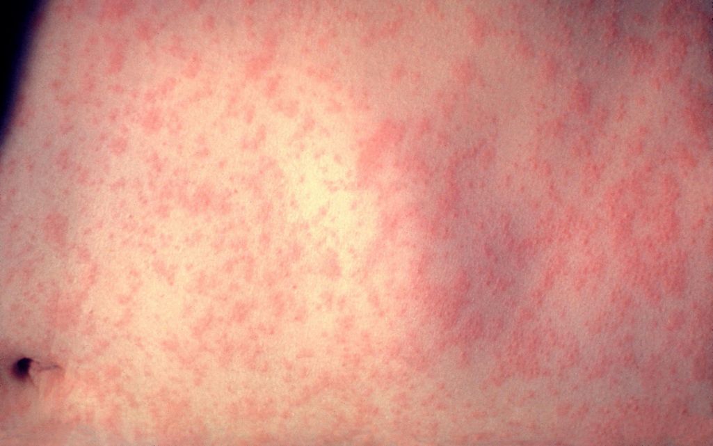 Адзёр (Фота: Dr. Heinz F. Eichenwald / CDC / Wikimedia)