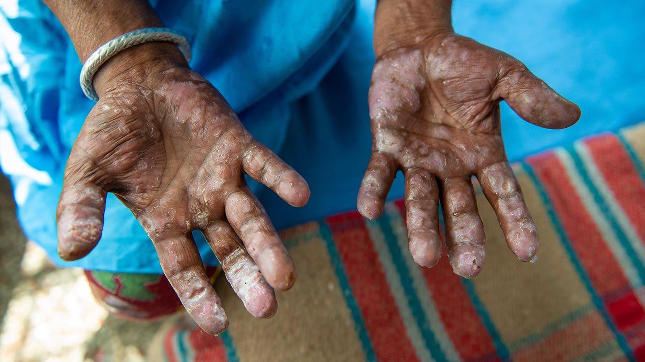 Trąd to choroba krajów biednych i technologicznie zacofanych (fot. Shutterstock/PradeepGaurs)